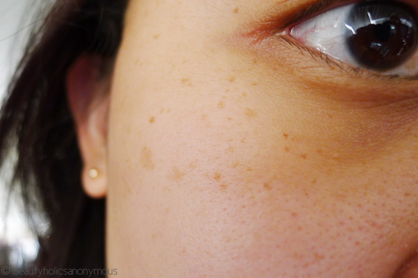 Hyperpigmentation